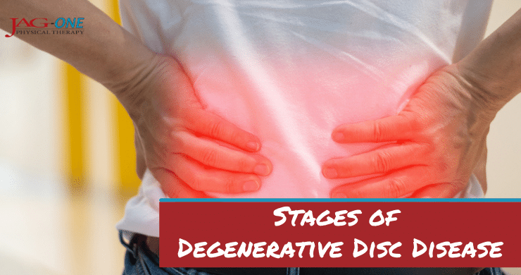 Stages of Degenerative Disc Disease